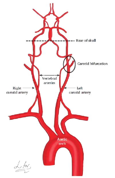 Doença carotídea e doença cerebrovascular